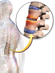 Find Relief for Degenerative Disc Disease BruceBlaus, CC BY-SA 4.0 <https://creativecommons.org/licenses/by-sa/4.0>, via Wikimedia Commons