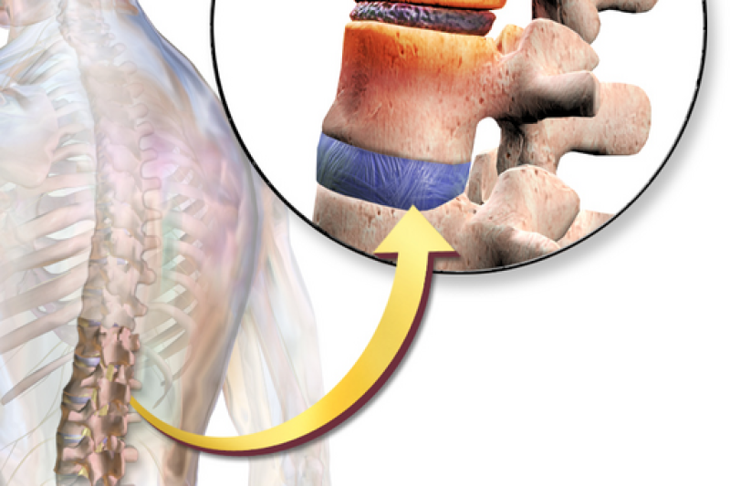 Find Relief for Degenerative Disc Disease and Back Pain BruceBlaus, CC BY-SA 4.0 , via Wikimedia Commons