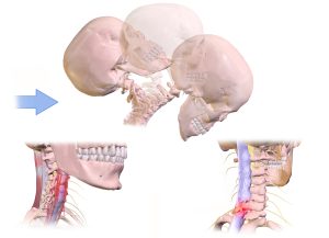 Whiplash Injury BruceBlaus, CC BY-SA 4.0 <https://creativecommons.org/licenses/by-sa/4.0>, via Wikimedia Commons
