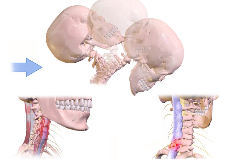 Whiplash Injury BruceBlaus, CC BY-SA 4.0 , via Wikimedia Commons